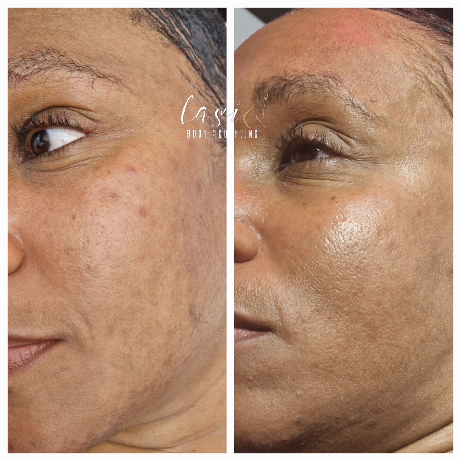 client 3d dermaforce treatment results